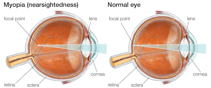 long eyeball causes myopia