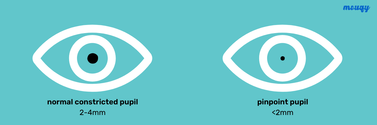 comparison between normal and pinpoint pupil size