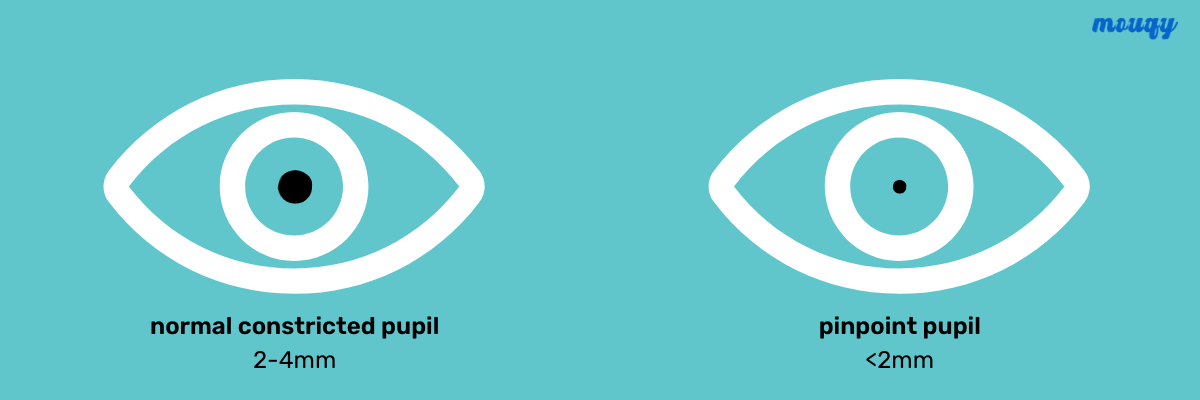seizure pinpoint pupils seizure pinpoint pupils