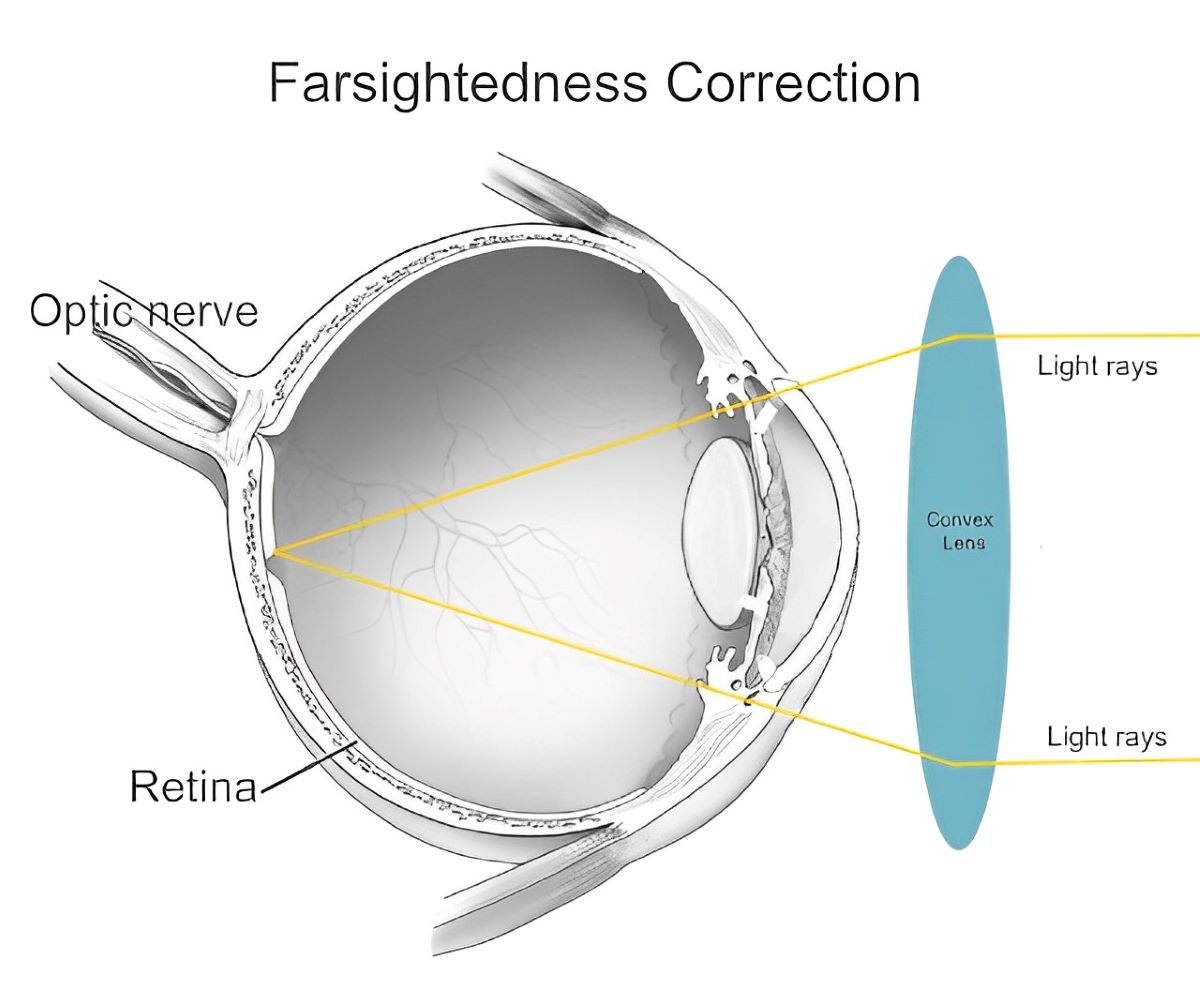 illustration of how convex lens correct farsightedness