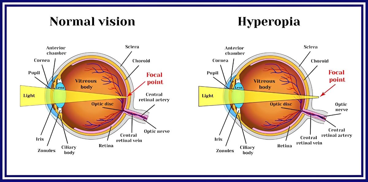 difference between normal vision and hyperopia