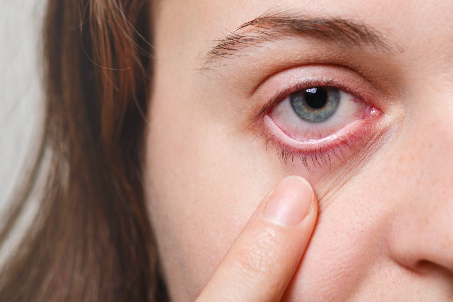 Woman showing her red eye with inflamed blood capillary due to itchiness