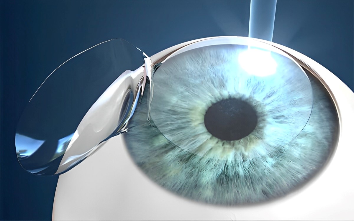 an illustration of how LASIK surgery can treat farsightedness