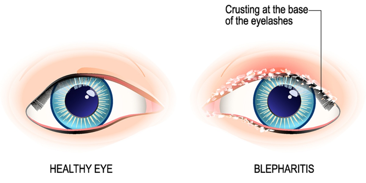 how normal eye and eye with blepharitis look