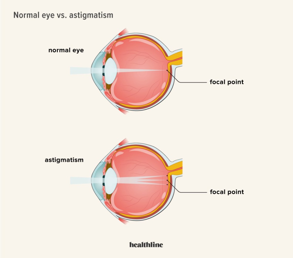 irregular lenses shape causes astigmatism and blurry vision