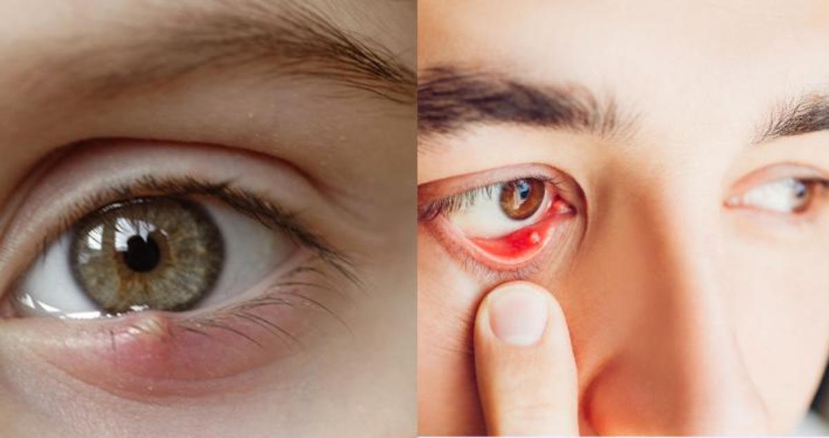 stye can be either internal or external