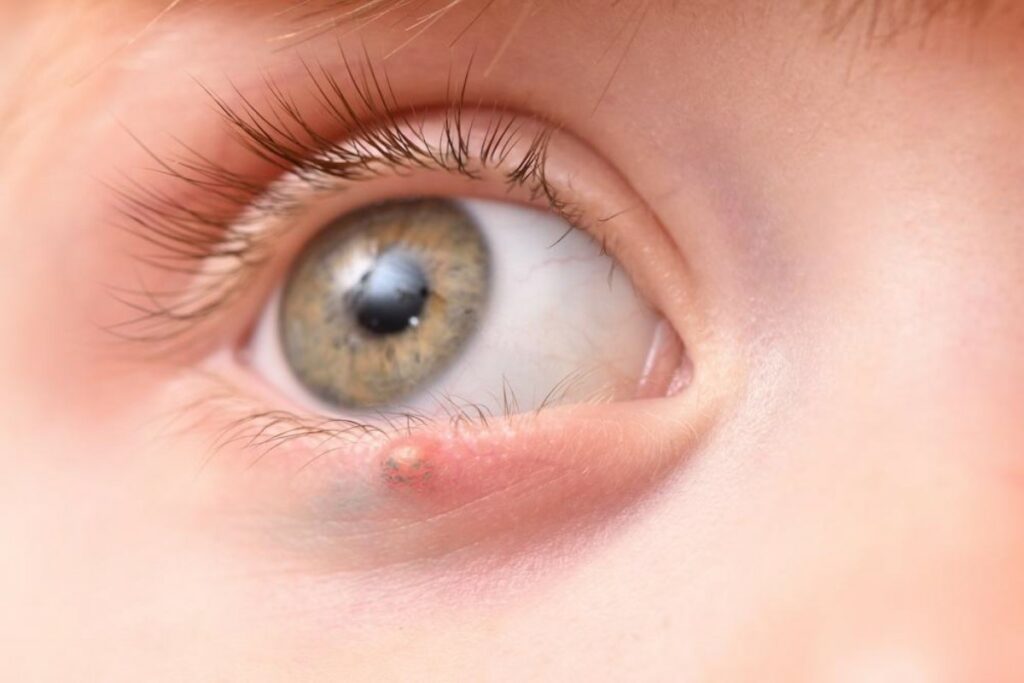 an external stye on the outside of an eyelid