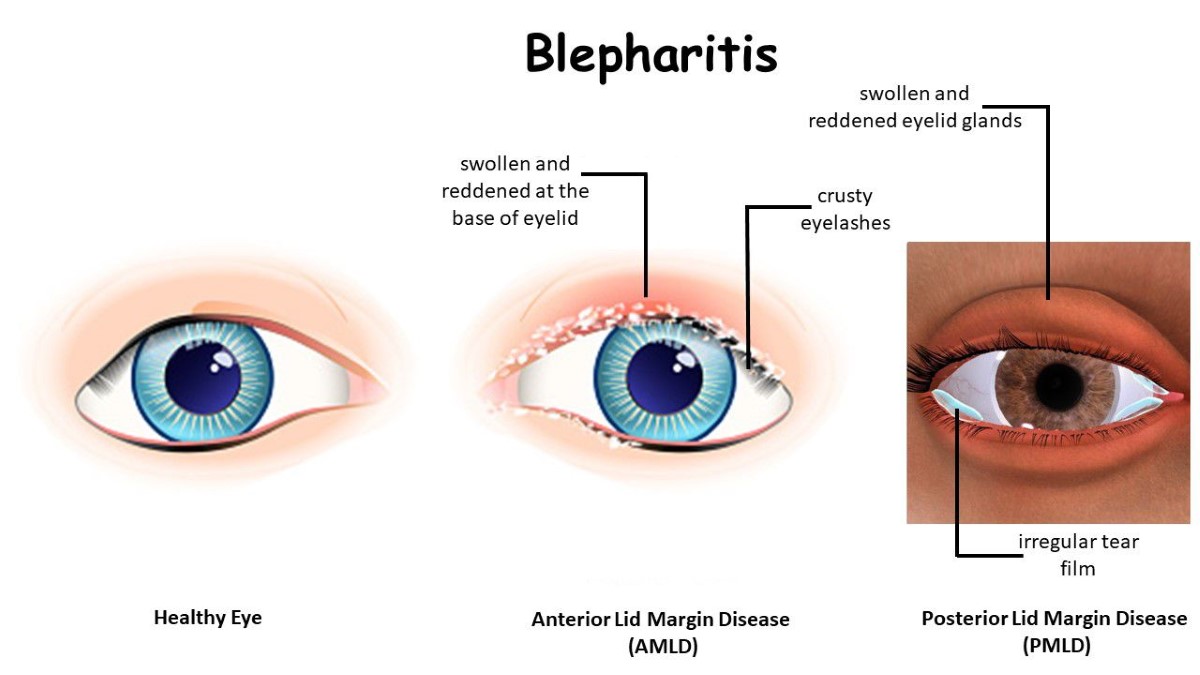eye crust due to blepharitis