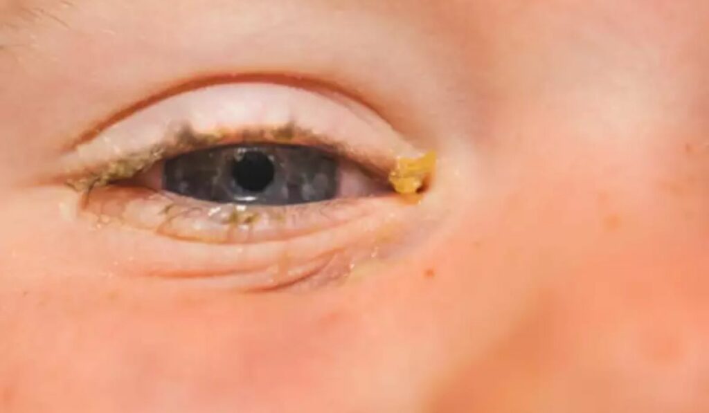 Crusty Eyes in the Morning Benign or Serious?