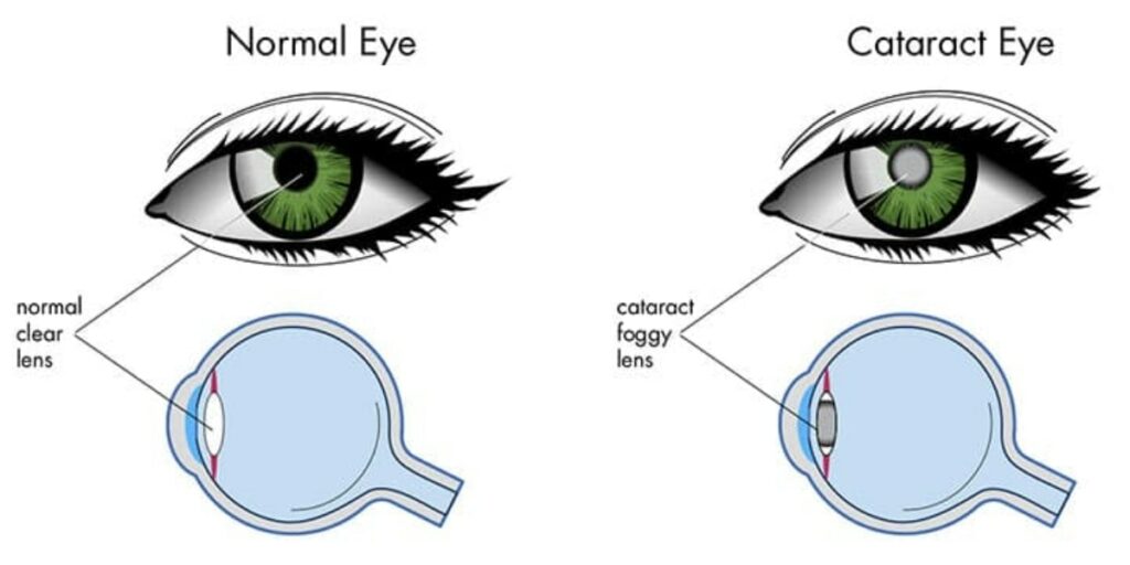 The Eye Lens What You Need to Know