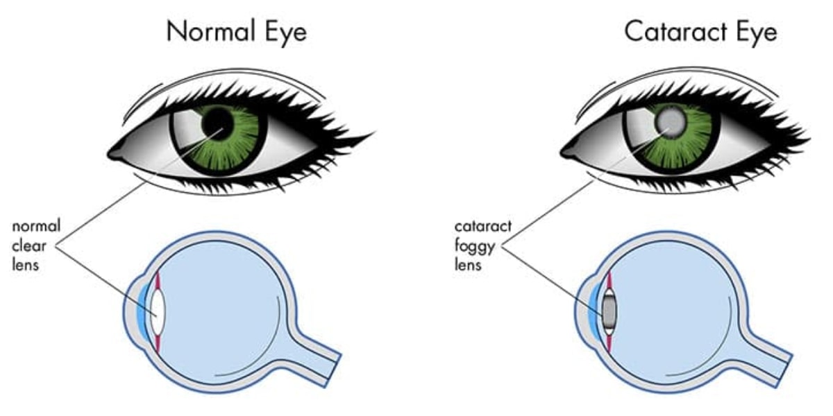 comparison between normal eye lens and eye lens with cataract