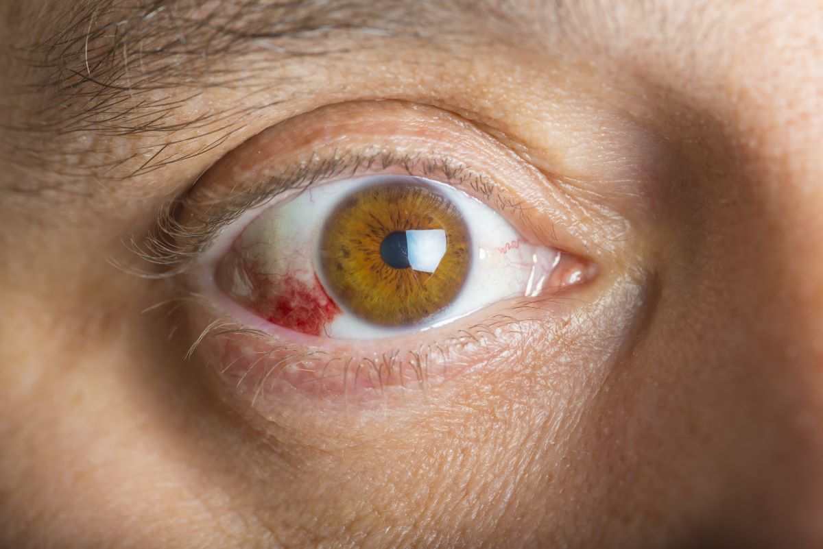 an eyeball with corneal ulcers