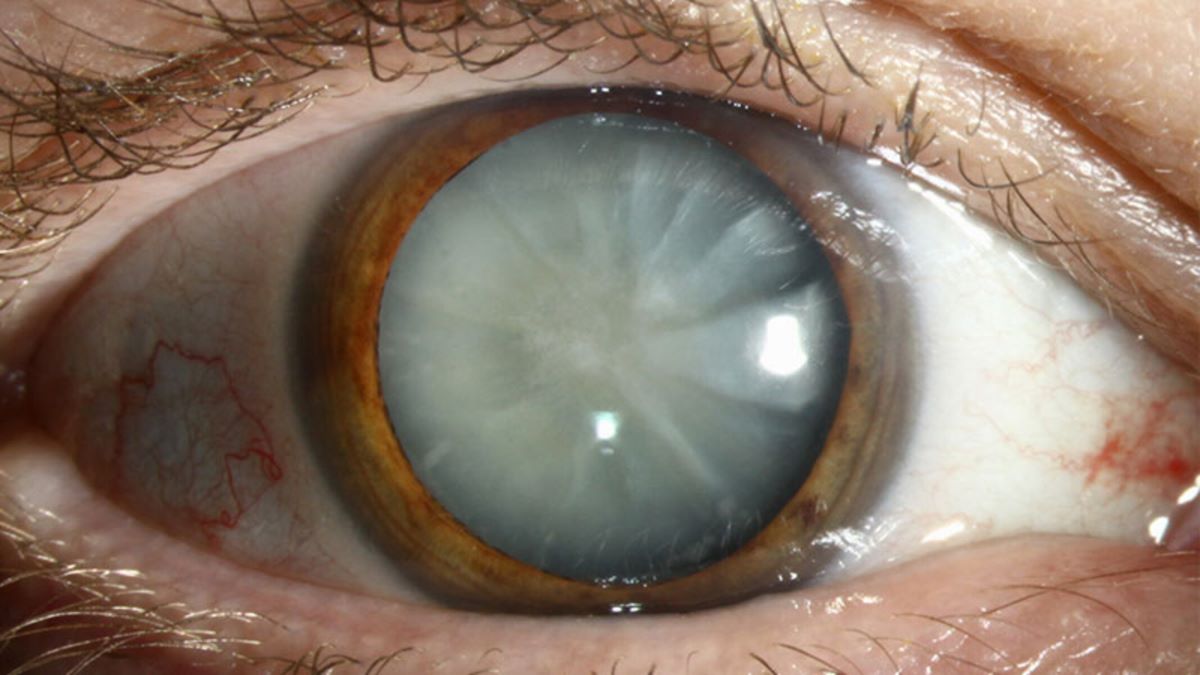 a closeup of an eye with cloudy lens due to cataract