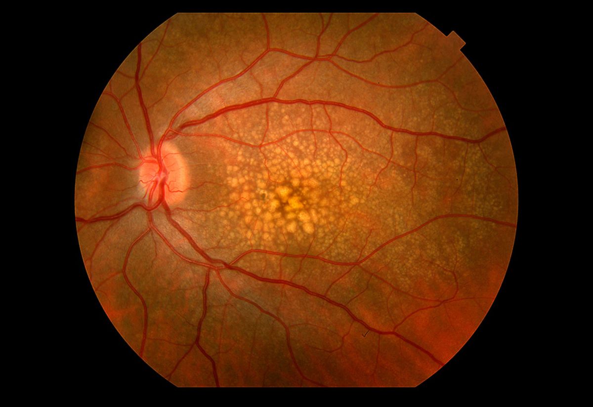 retinal nerve fiber in an eyeball indicating macular degeneration