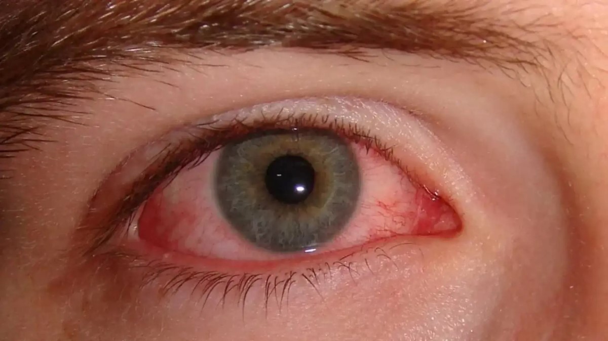 pink eye affects vision