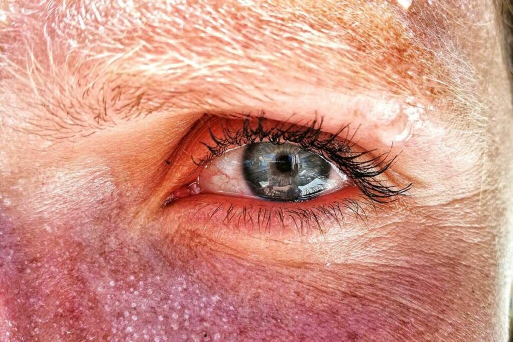 redness inflammation sunburned eyes symptoms