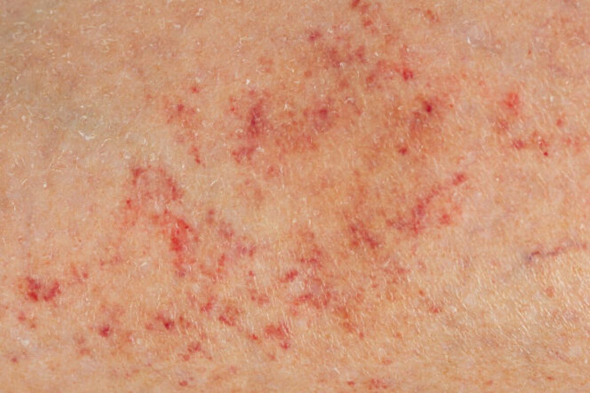spots or rashes can be a sign of petechiae