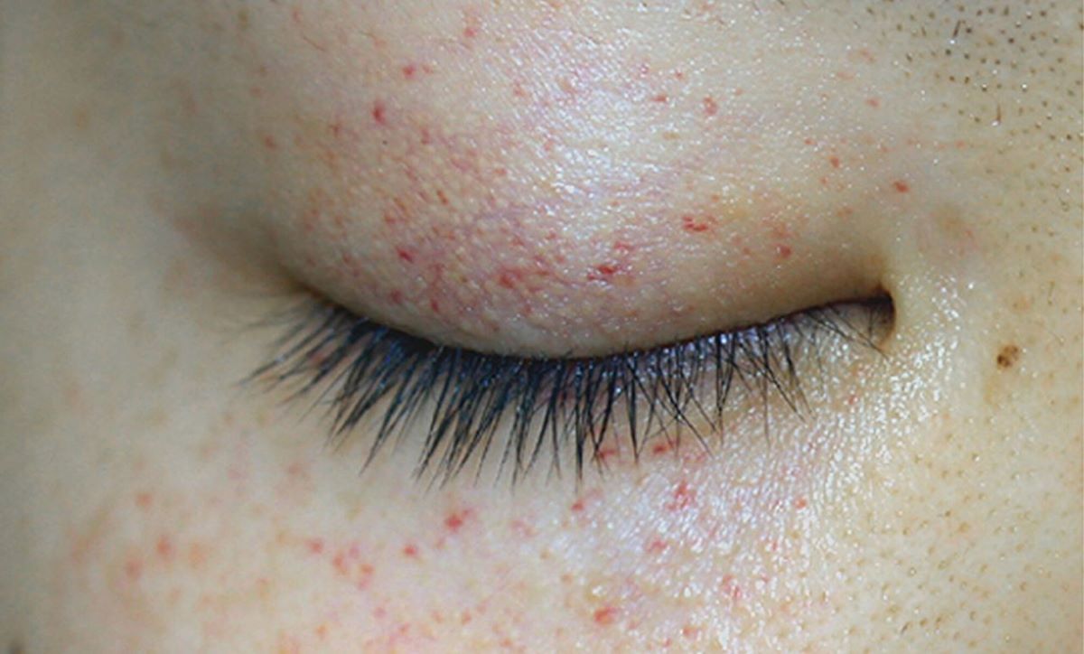 petechiae red dots around eyes