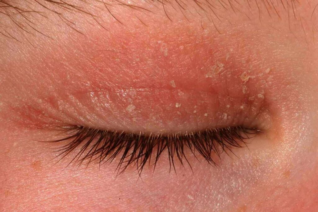 eyelid dermatitis