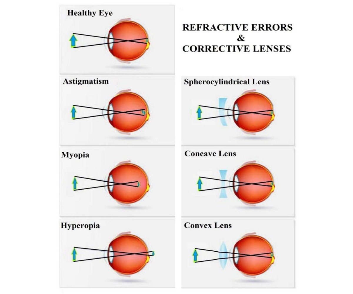 illustration of how corrective lenses correct refrative errors