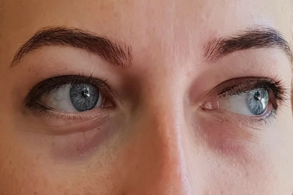 symptoms and signs of eye bags or puffy eyes