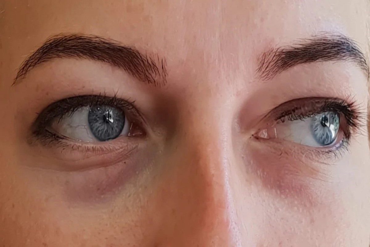 symptoms and signs of eye bags or puffy eyes