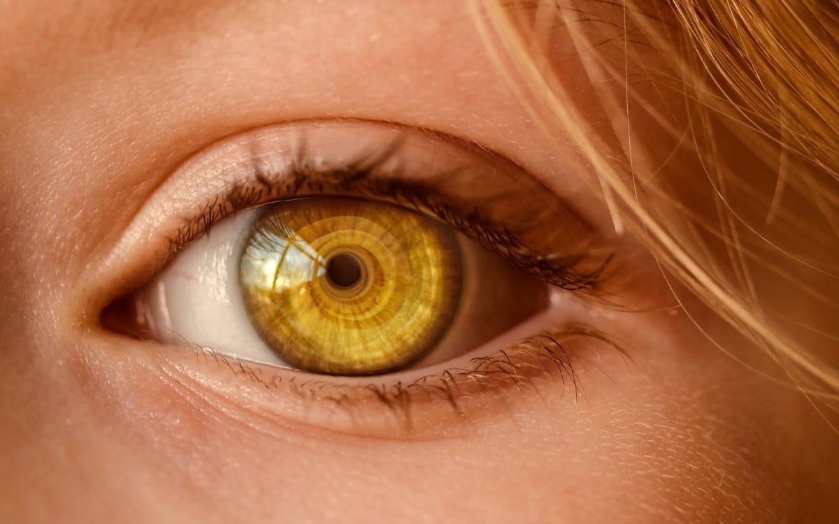 woman with yellow eyes with eye condition
