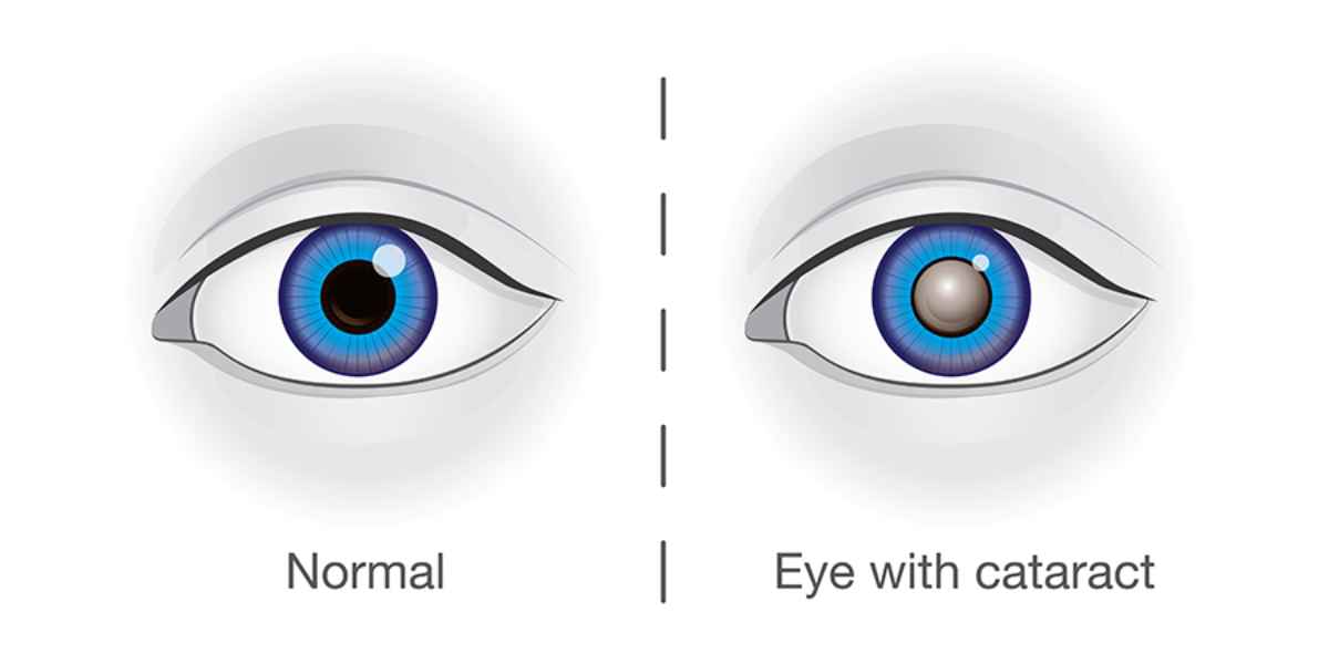 Illustration of cataracts, which occur when the eye's natural lens becomes cloudy