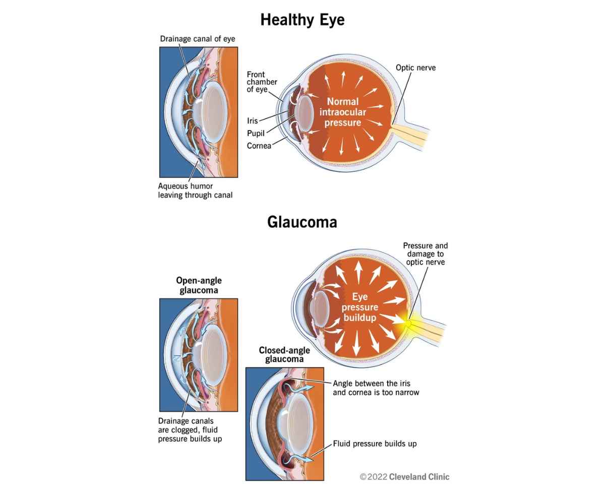 Illustration of how glaucoma can cause damage to the optic nerve and eventually lead to blindness if left untreated