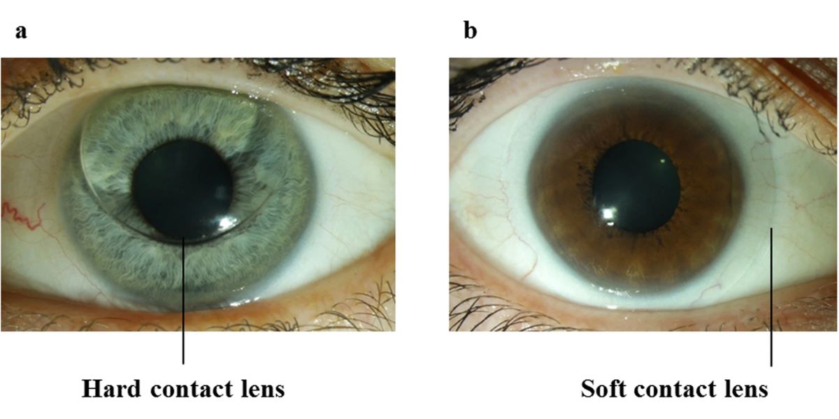 hard vs soft contact lenses