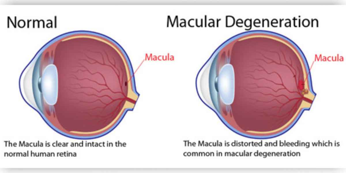 Illustration of how macular degeneration affects the central part of the retina responsible for detailed vision
