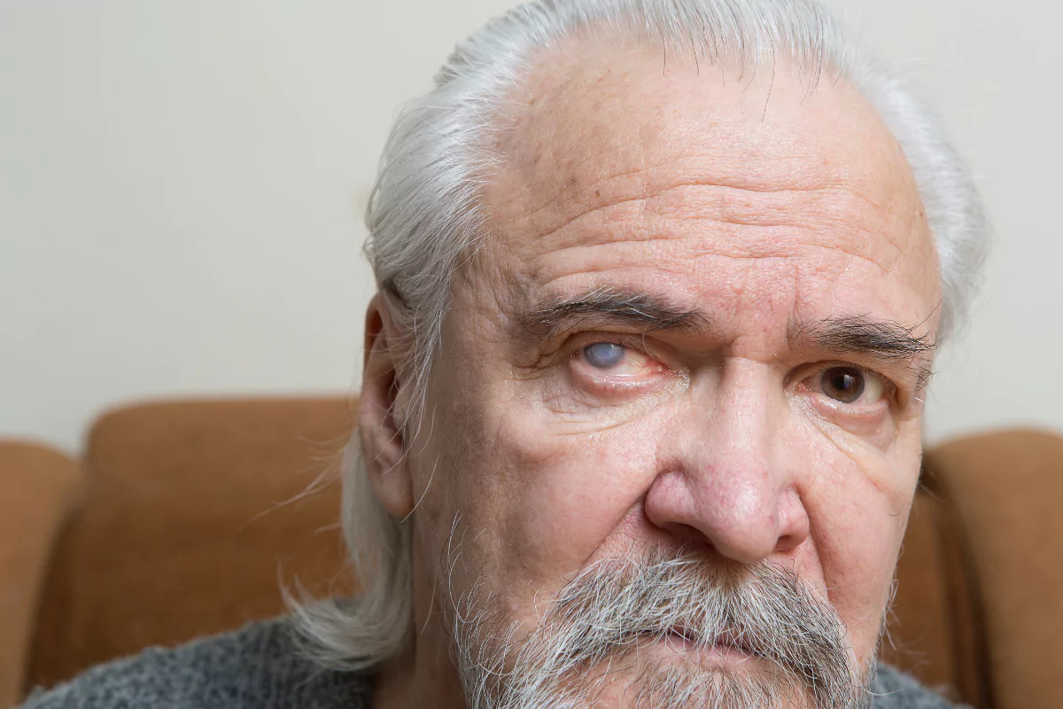 man with cataract in one eye