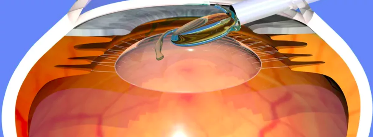 implantable lens surgery involves the insertion of a synthetic lens into the eye