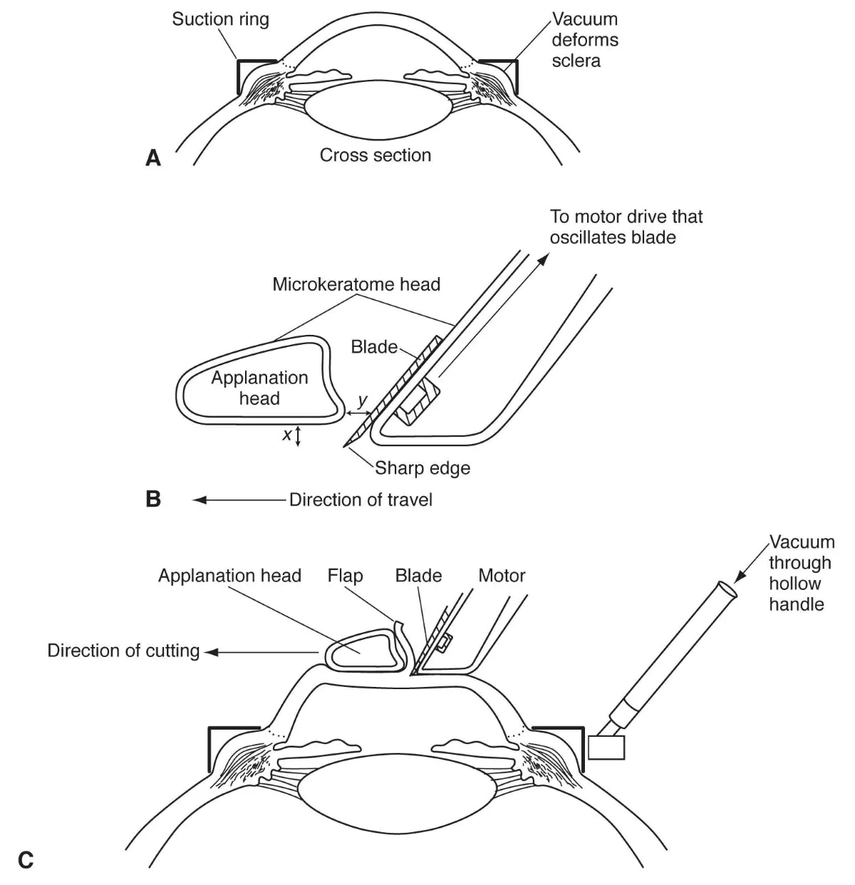 illustration of what microkeratome does