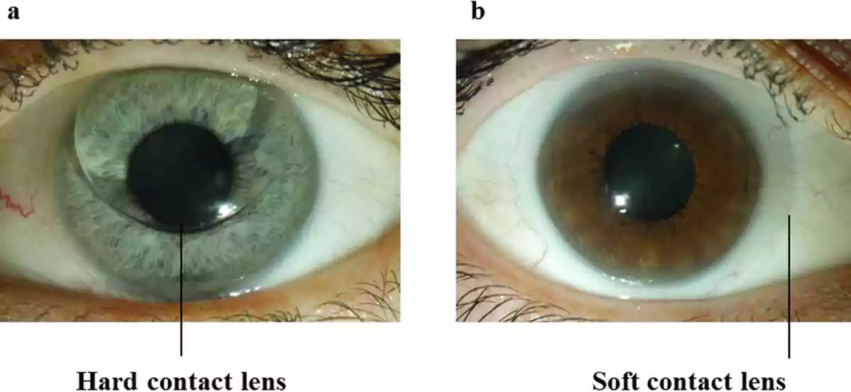 physical difference between hard and soft contact lenses
