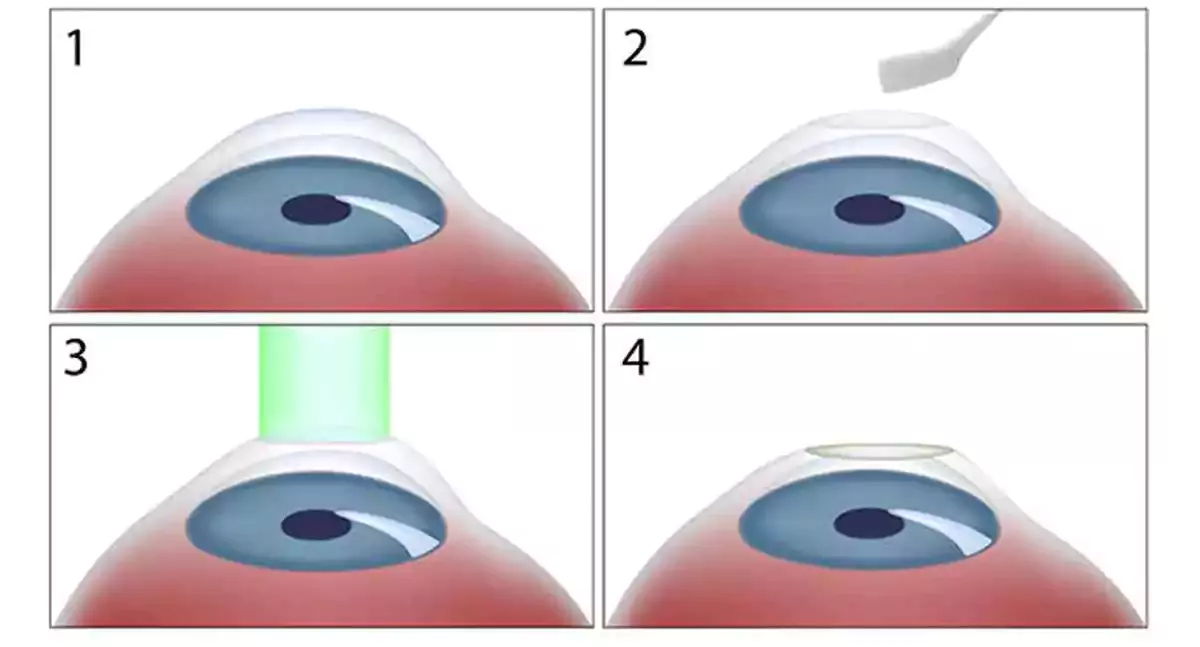 step by step of photorefractive keractectomy