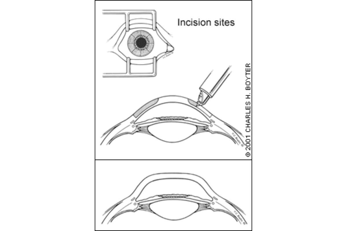 illustration of what radial keratotomy does